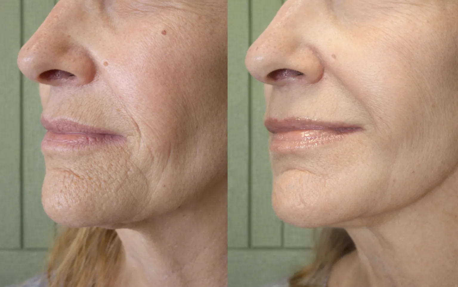 Who is RF microneedling for?